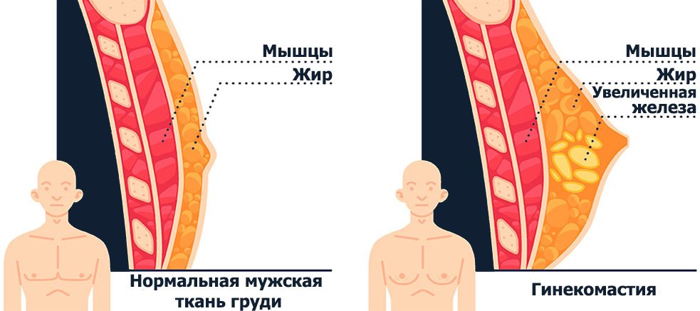 схема нормальной мужской ткани груди и гинекомастии