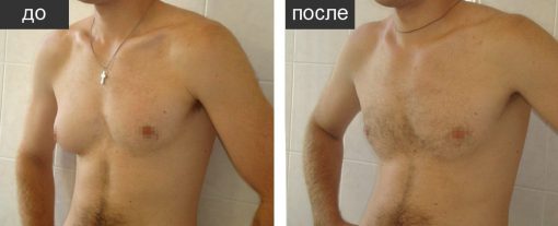 липосакция грудных желез у мужчин результат