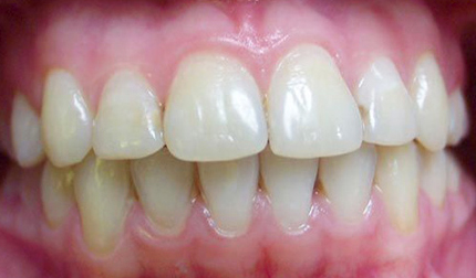 Зубы после лечения гипоплазии
