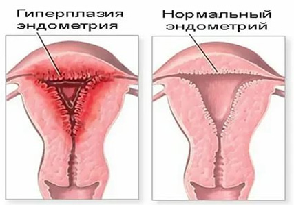 Гиперплазия эндометрия в сравнении с нормальной эндометрий