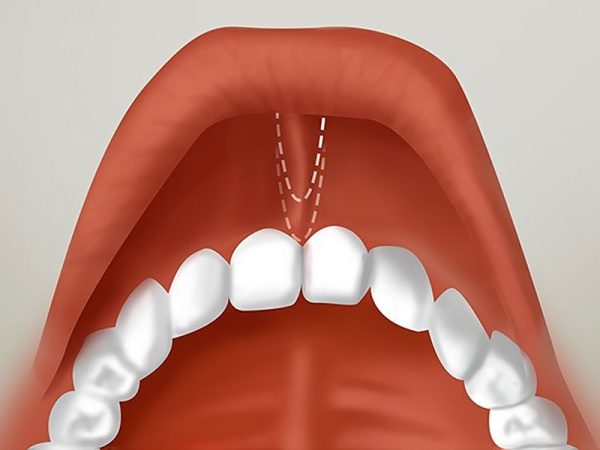 линии иссекания и смещения участка уздечки губы