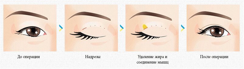 схема проведения блефаропластики азиатских глаз