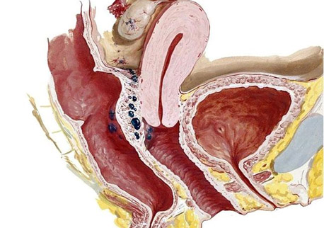 Ретроцервикальный эндометриоз на картинке