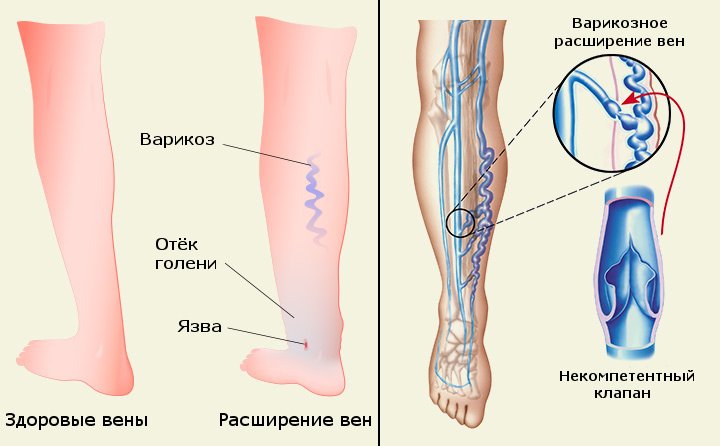 здоровые вены нижней конечности и варикозное расширение вен ног