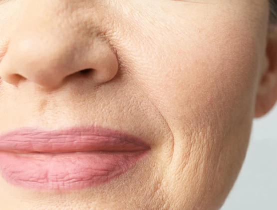 Как убрать кисетные морщины