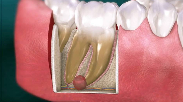 Киста на корне зуба — удалять или лечить?
