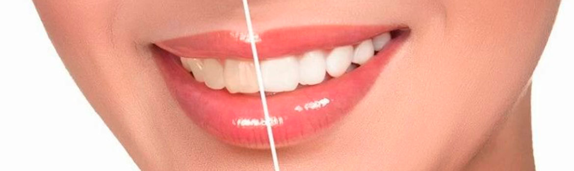 Что нельзя есть после отбеливания зубов