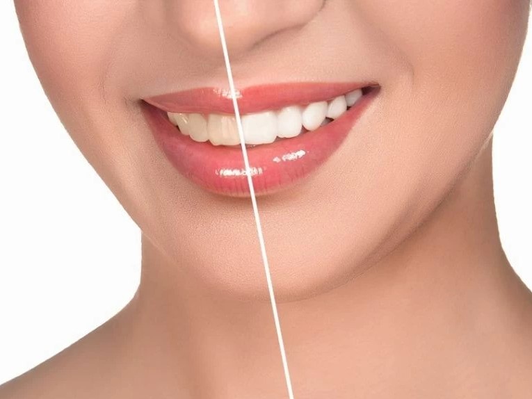 Что нельзя есть после отбеливания зубов