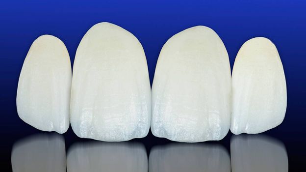 Всё о композитных винирах