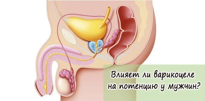 Влияние варикоцеле на потенцию