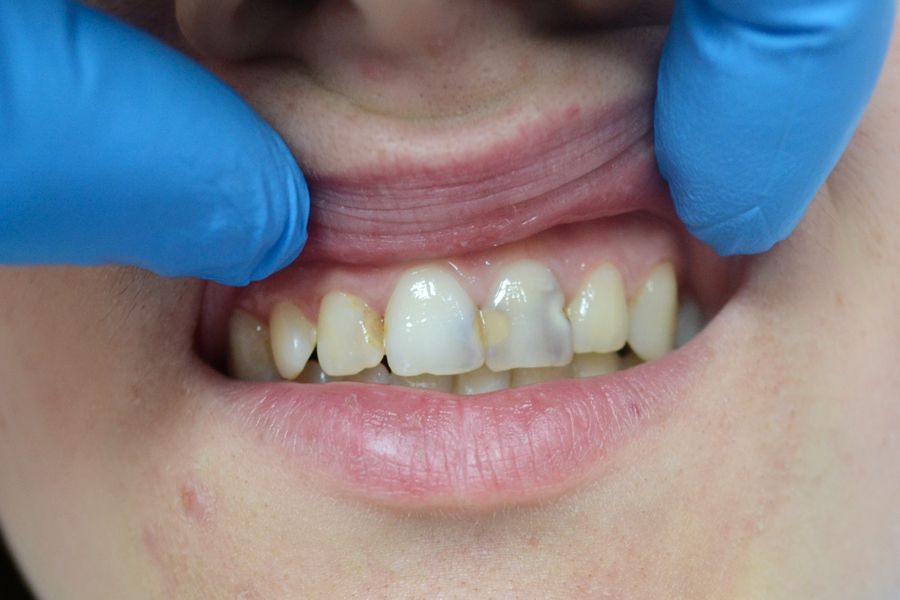 Как предотвратить кариес зубов?