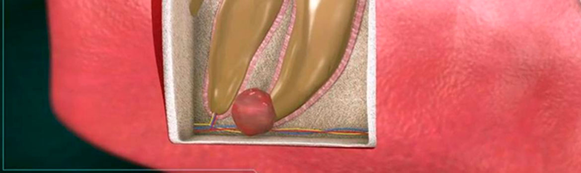 Киста на корне зуба — удалять или лечить?