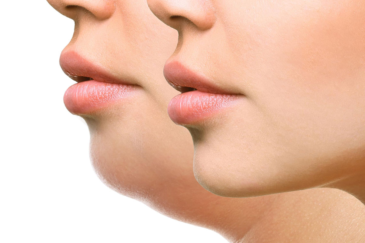 Как убрать второй подбородок