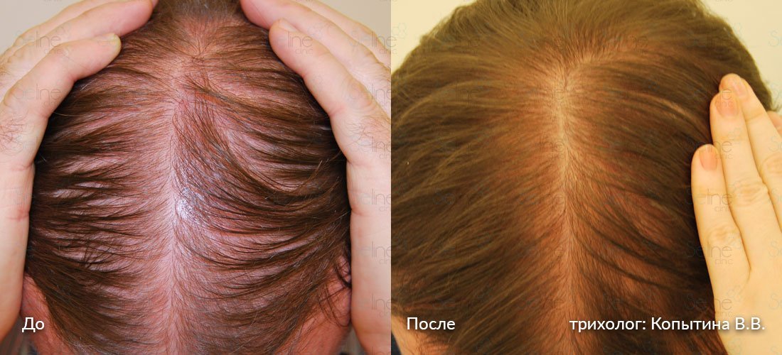 Лечение выпадения волос у женщин в Москве: цены, фото до и после, отзывы |  Стоимость лечения выпадения волос у женщин в клинике Seline