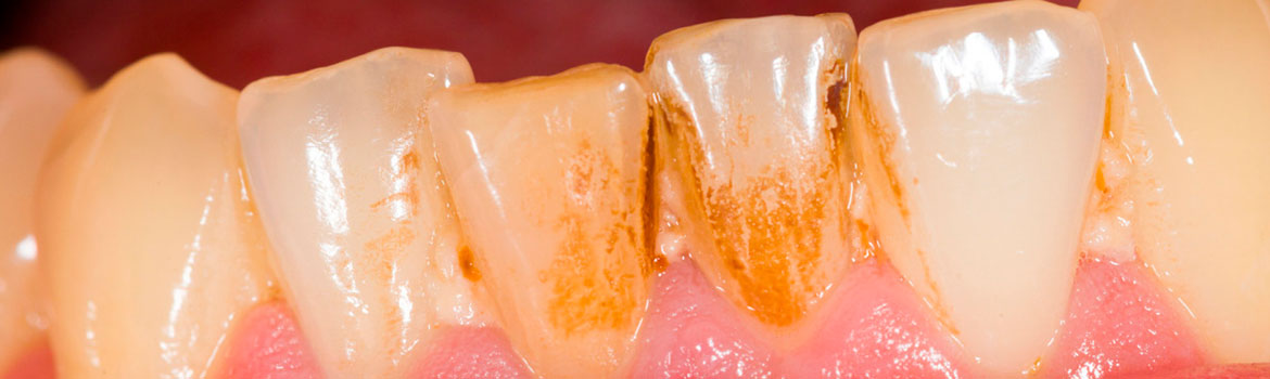 Как избавиться от чёрного налёта на зубах?