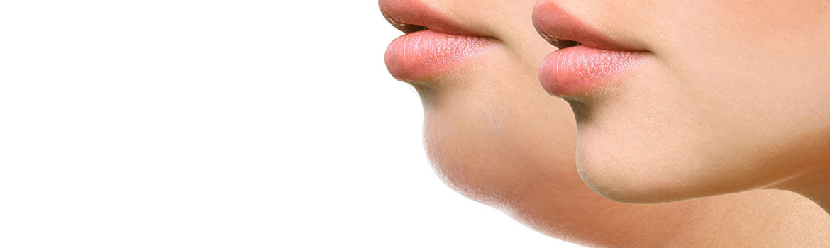 Как убрать второй подбородок