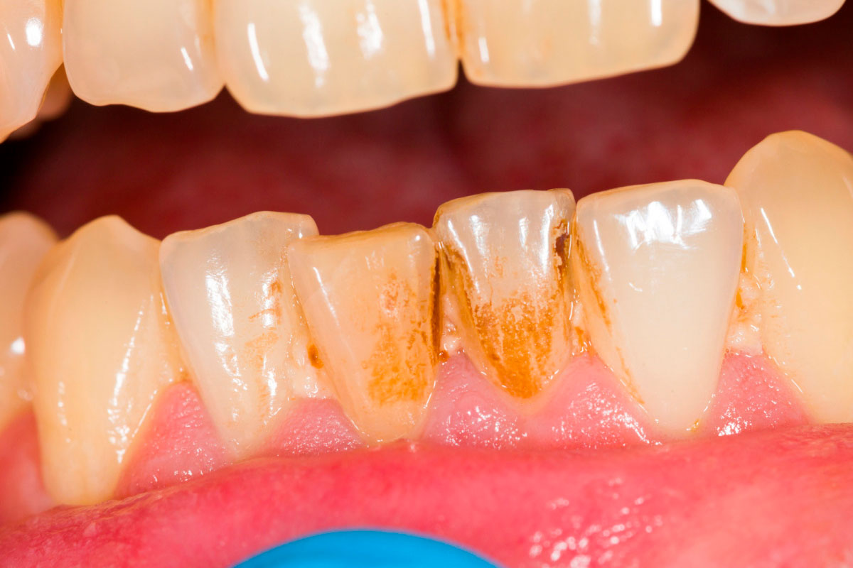 Как избавиться от чёрного налёта на зубах?