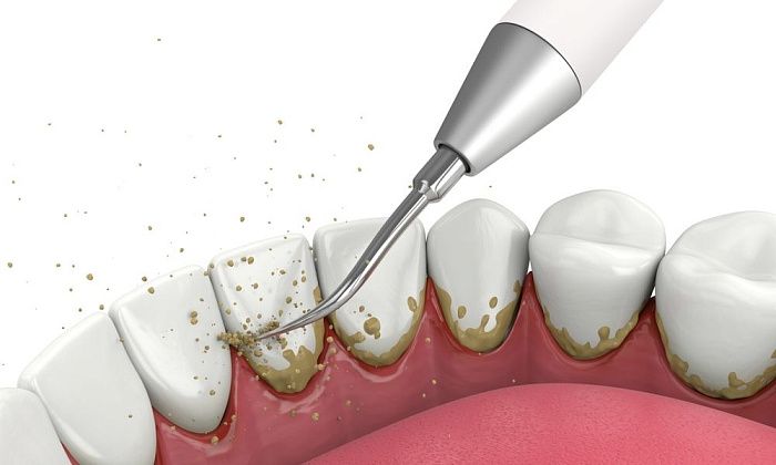 Удаление зубного налета