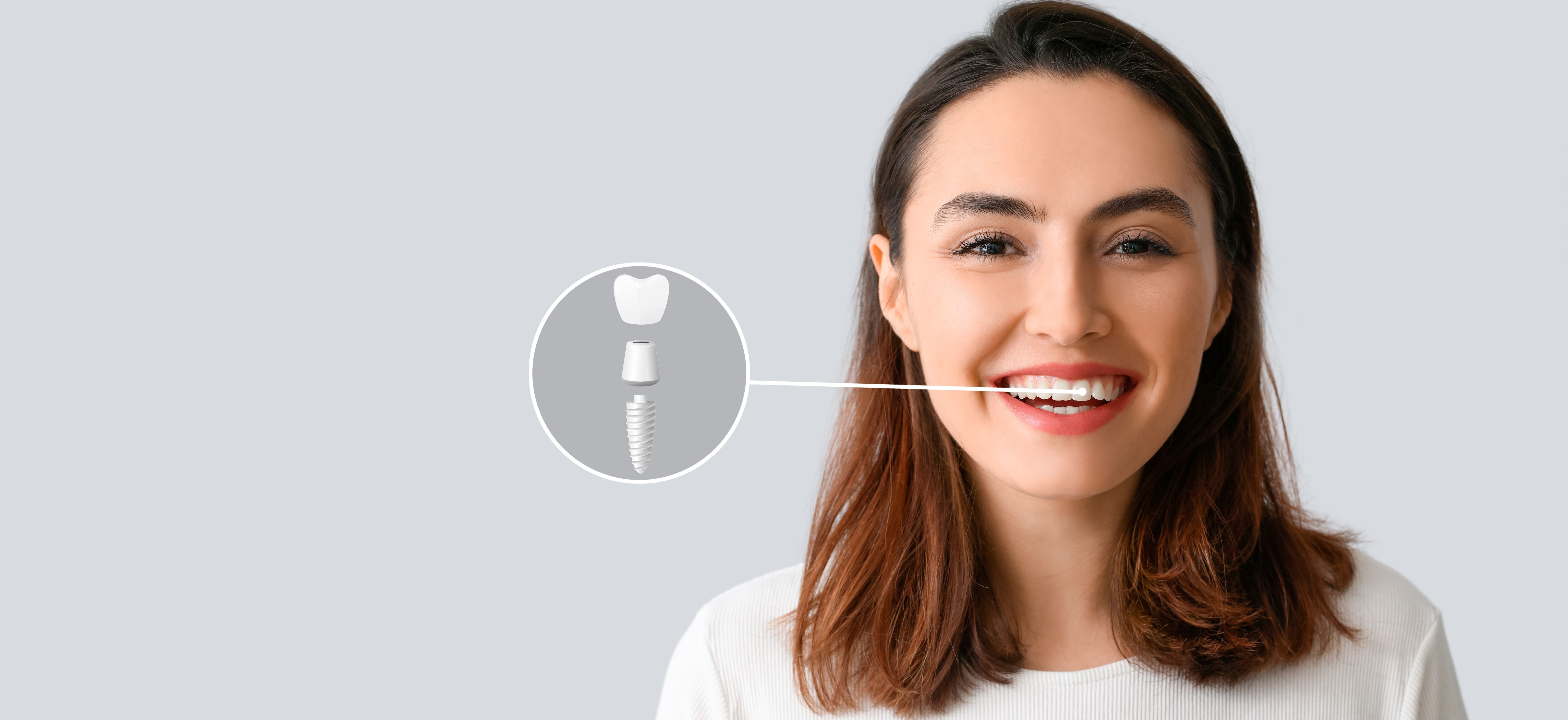 Имплантация Dentium