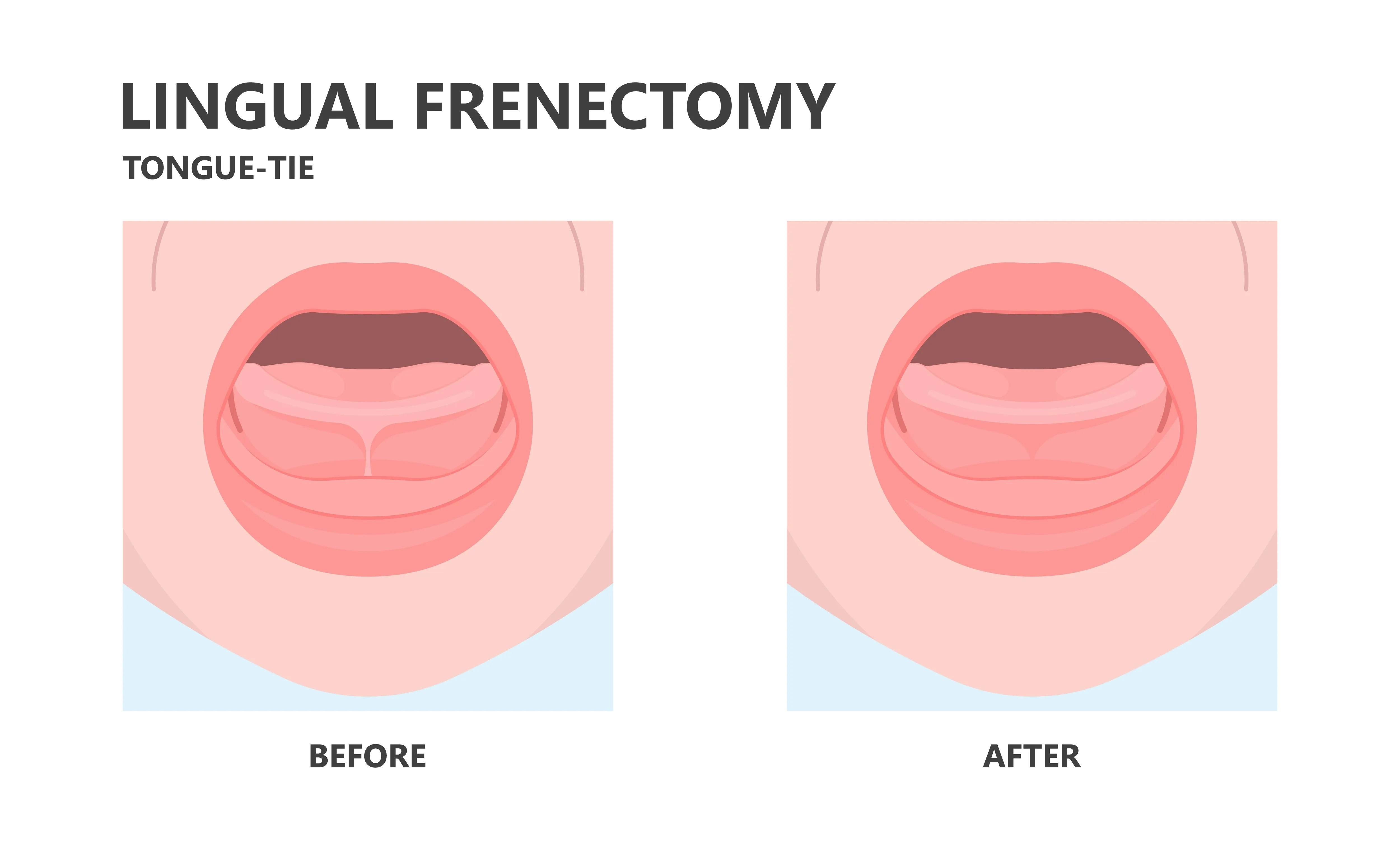 Пластика уздечки языка