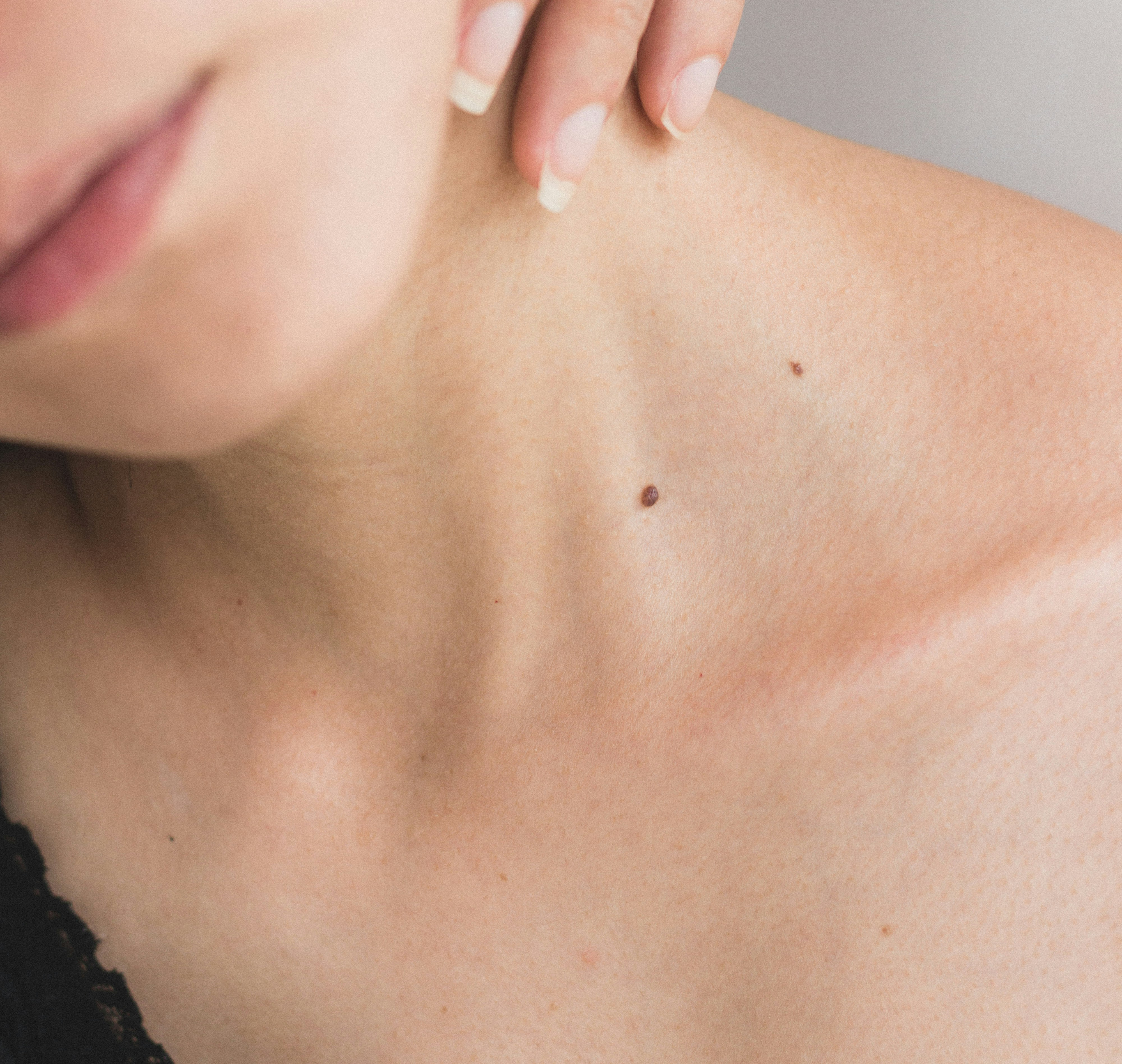 Радиоволновое удаление папиллом