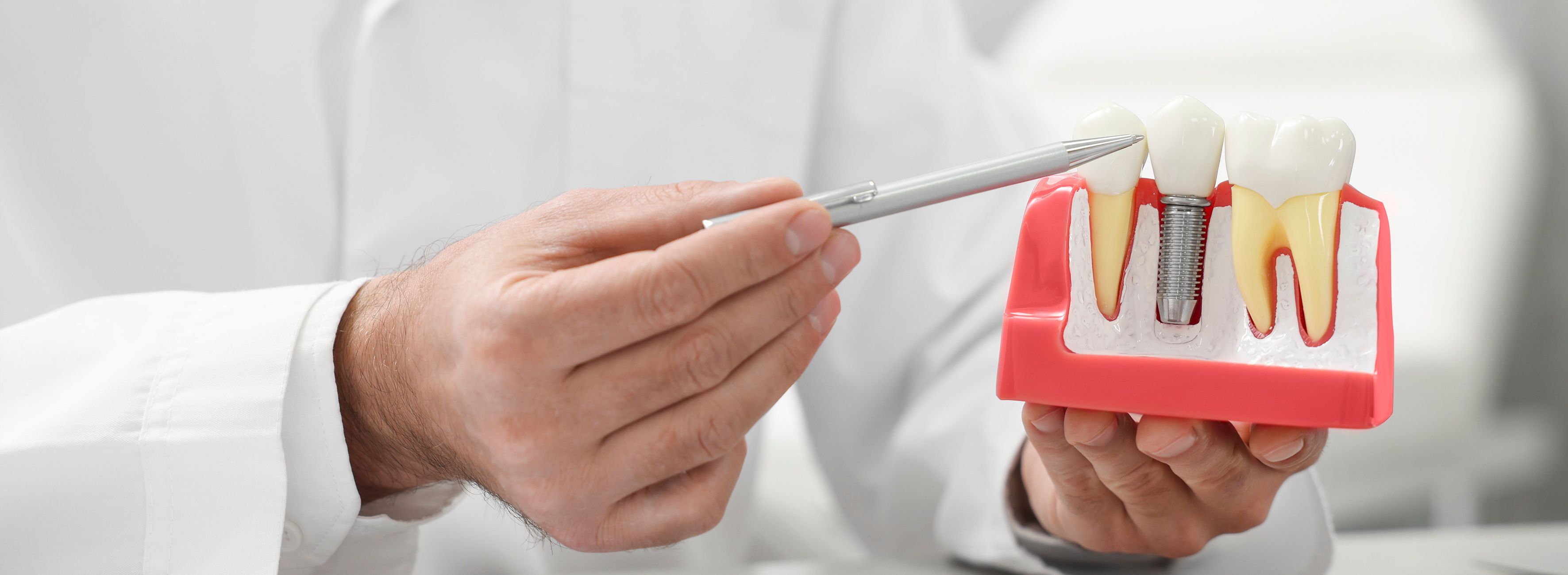 Имплантация Astra Tech