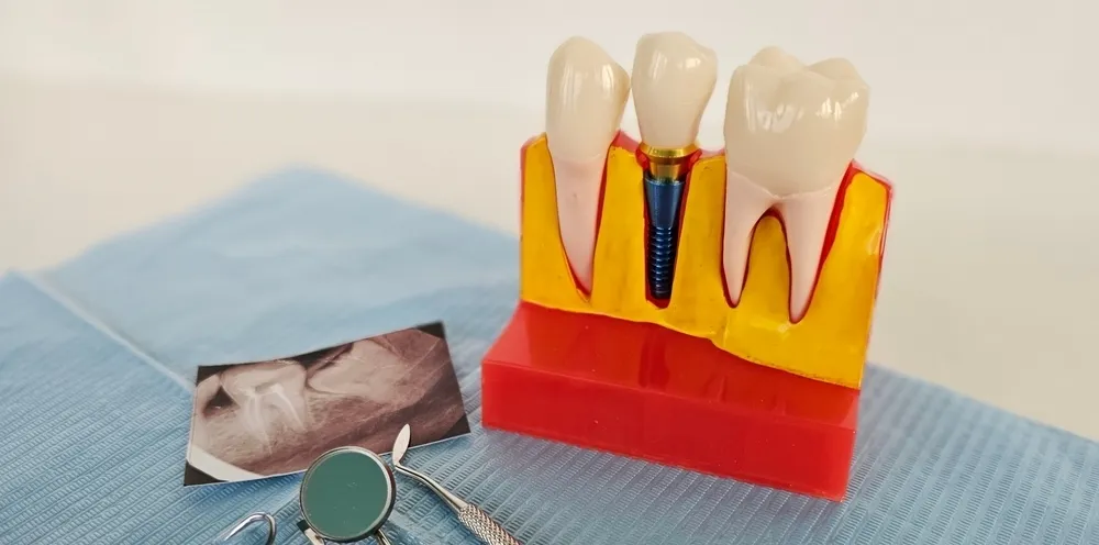 Удаление корня зуба